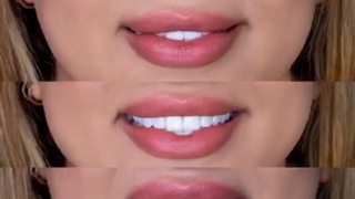 لمینت سرامیکی دندان در اهواز