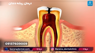 مراحل عصب کشی دندان