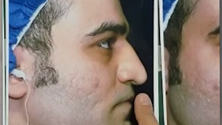 جراحی بینی گوشتی و پهن با انحراف شدید