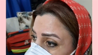 بوتاکس پیشانی و دور چشم در کلینیک پوست امیدوار
