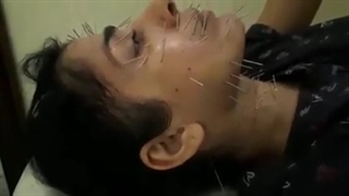 لیفت و جوانسازی صورت با طب سوزنی