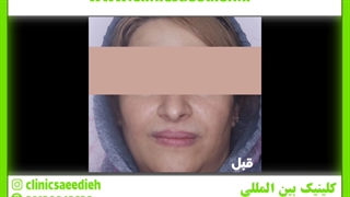 تزریق چربی اصلاح فرم صورت