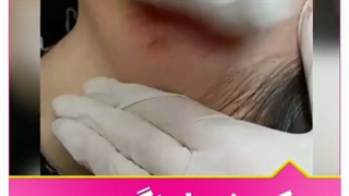 میکرونیدلینگ صورت جرمگیری