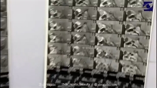 جراحی تومور کاسه چشم در کودک چهار ساله