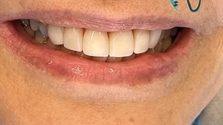 کامپوزیت ونیر