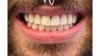 اصلاح طرح لبخند