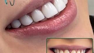 تعویض کامپوزیت ونیرهای قدیمی بیمار