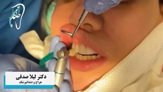 کامپوزیت ونیر