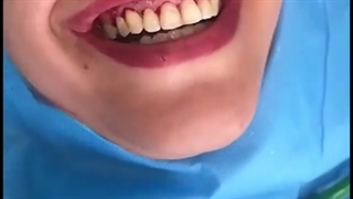 لیفت لثه و انجام کامپوزیت ونیر کربوکسی تراپی