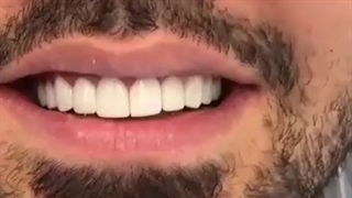 تعویض روکش چهار دندان قدامی