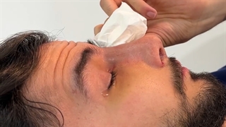 بازکردن گچ بینی بعد از 5 روز!!!!!