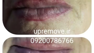 بهترین مرکز ریمو تاتو رشت