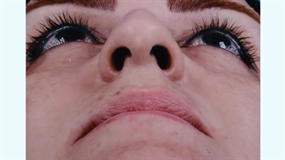 حس خوب رضایت بخش مراجعه کننده از جراحی رینوپلاستی