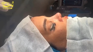 ویدیو بلافاصله بعد از جراحی رینوپلاستی کاملا طبیعی و متناسب با چهره