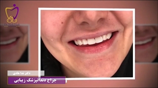 نمونه کار کامپوزیت دندان