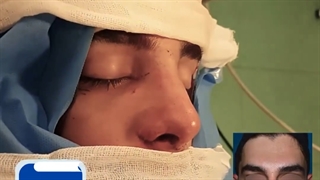 جراحی رینوپلاستی کاملا طبیعی و متناسب با چهره توسط دکتر حمیدرضا فتحی کاشت مو