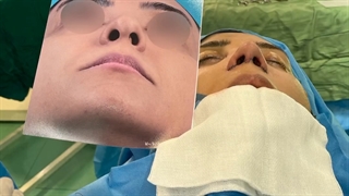 جراحی رینوپلاستی بلافاصله بعد از جراحی