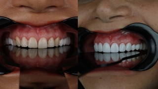 بهترین متخصص کامپوزیت کردن دندان | مراحل کامپوزیت کردن دندان | قیمت هر واحد ونیر کامپوزیت