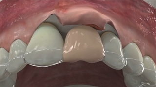 ایمپلنت دندان؛دندانپزشکی آرامش