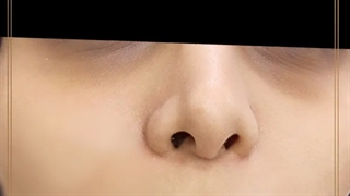 فیلر زیر چشم