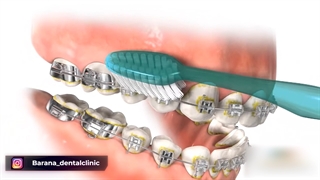 نحوه مسواک زدن روی برکت های ارتودنسی
