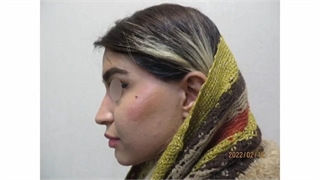 جراحی بینی غضروفی