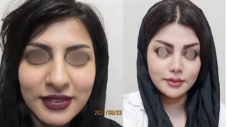 عمل بینی طبیعی