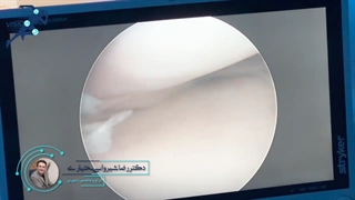 ترمیم منیسک