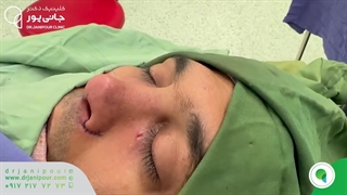 جراحی بینی گوشتی با پوستی ضخیم | دکتر مسعود جانی پور