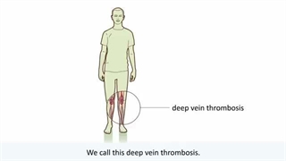 ترومبوز - چیست و چگونه درمان می شود؟