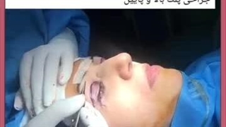 رفع چین و چروک زیر چشم با بلفاروپلاستی پلک