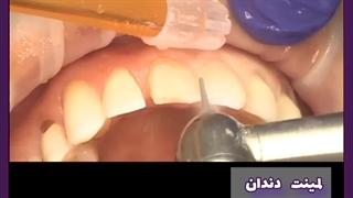 ایا لمینت دندان عمری است