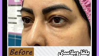 بهترین سن برای عمل بلفاروپلاستی