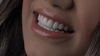 نمونه کار لمینت دندان در کلینیک بارانا