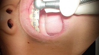 اصلاح طرح لبخند