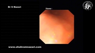 خارج کردن استنت مجرای اصلی صفراوی (کولدوک) با آندوسکوپ