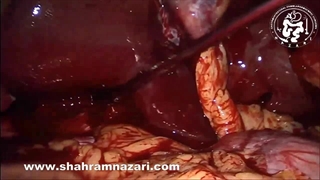 کله سیستکتومی لاپاروسکوپی