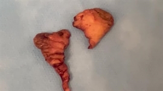 فیلم نمونه کار لابیاپلاستی