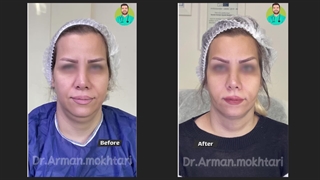 نمونه کار جراحی لیپوفیس صورت