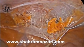 ترمیم فتق دوطرفه