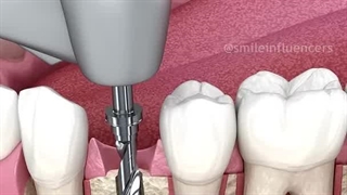 ایمپلنت دندان؛ تجدید لبخند با دقت و نوآوری