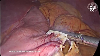 لاپاراسکوپی اسلیو گاسترکتومی