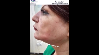 انجام لیفت صورت با نخ (4)