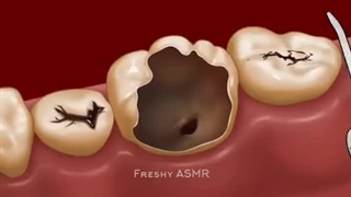 *Hamonium Asmr 2024*درمان کم موی و شوره و خارش سر؛ترمیم سه دندان پوسیده سیاه-قسمت شانزدهم