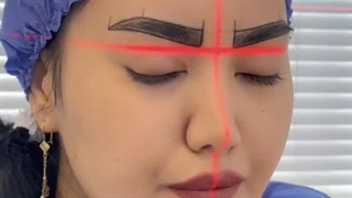 کاشت ابرو با تکنیک سوپر نچرال