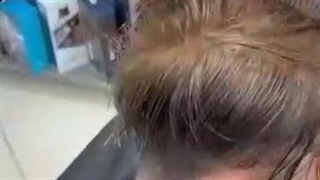 پروتز مو کرج | ورناپ